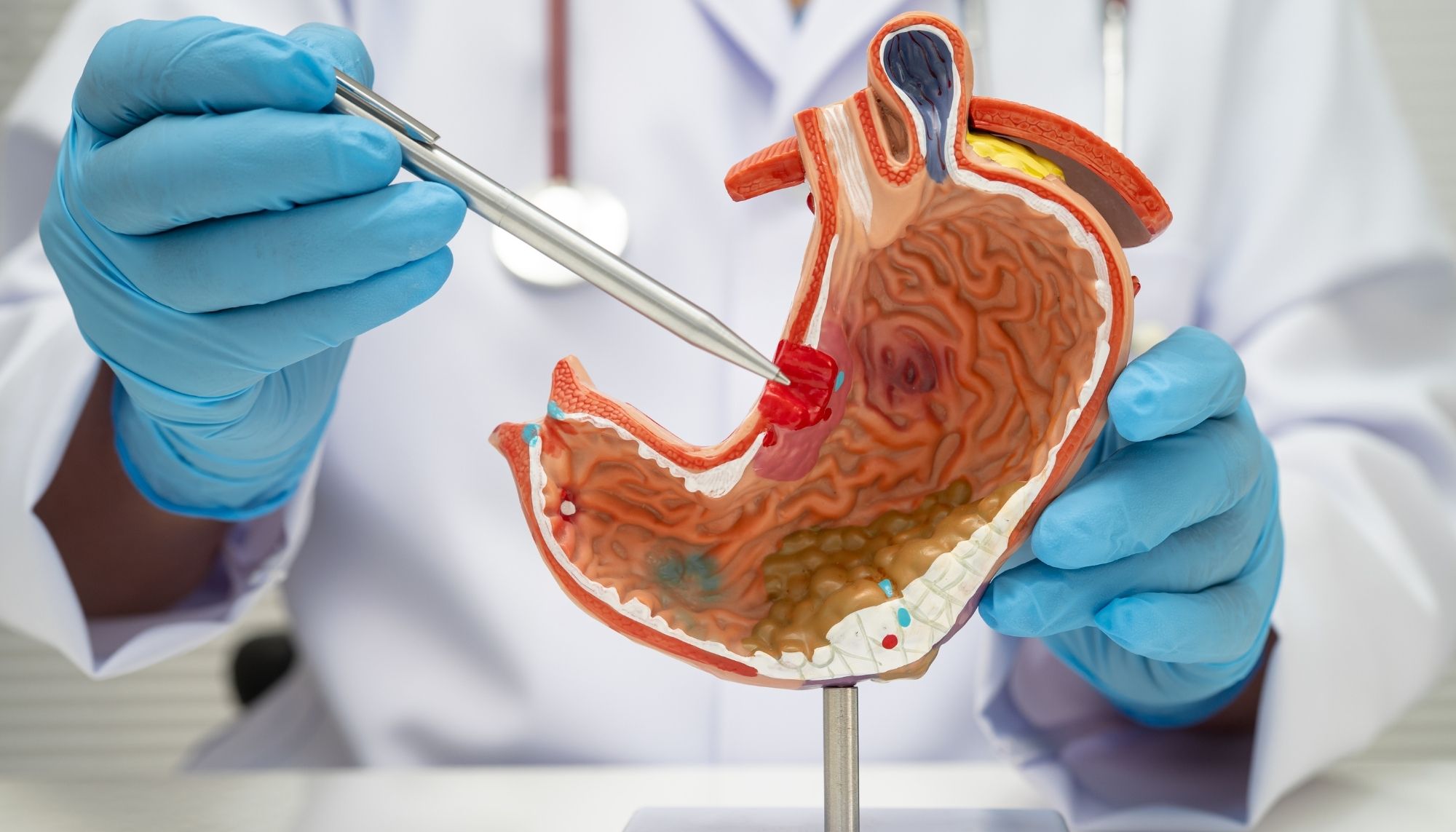 Stomach Ulcers