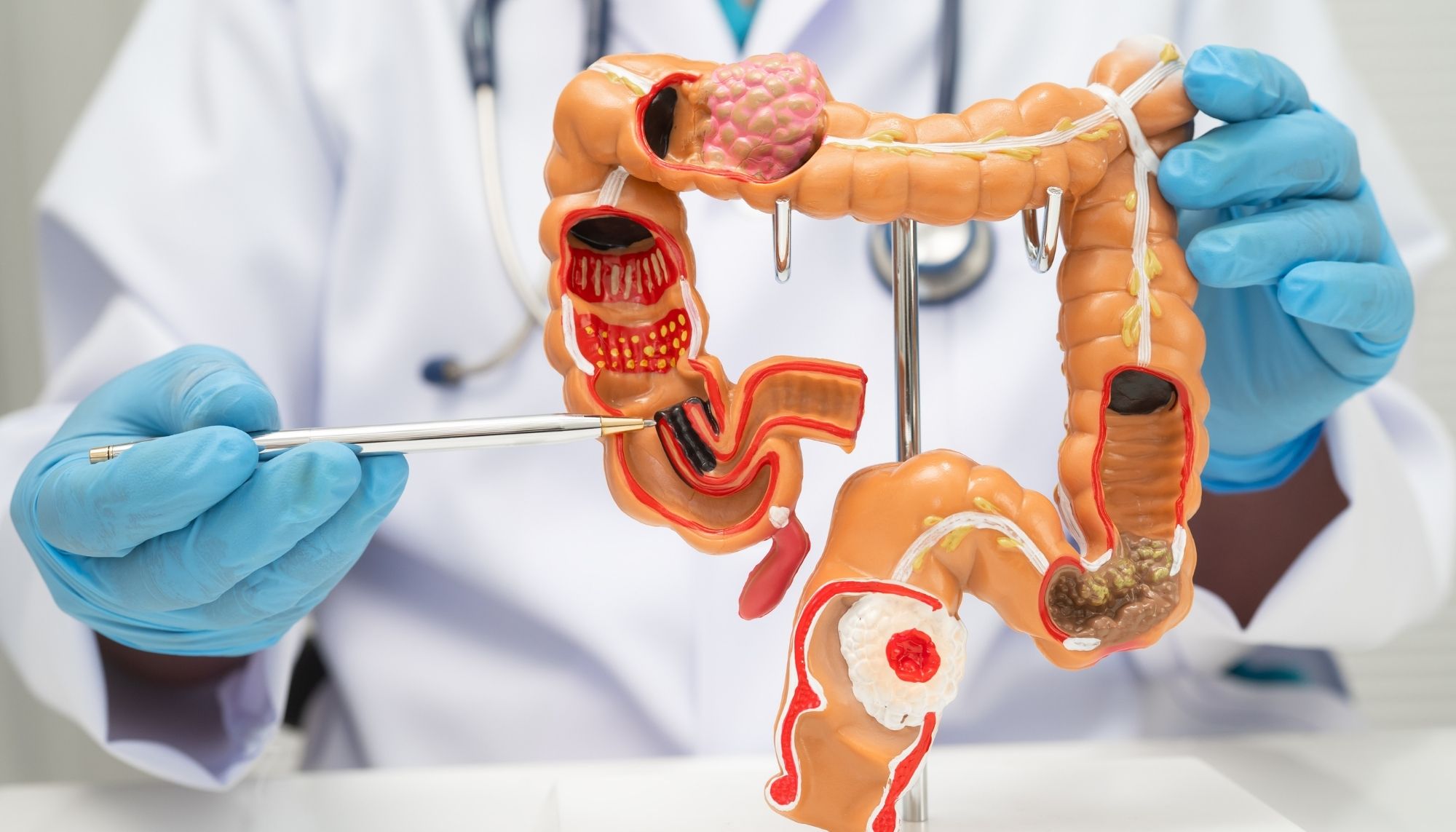 Ulcerative Colitis