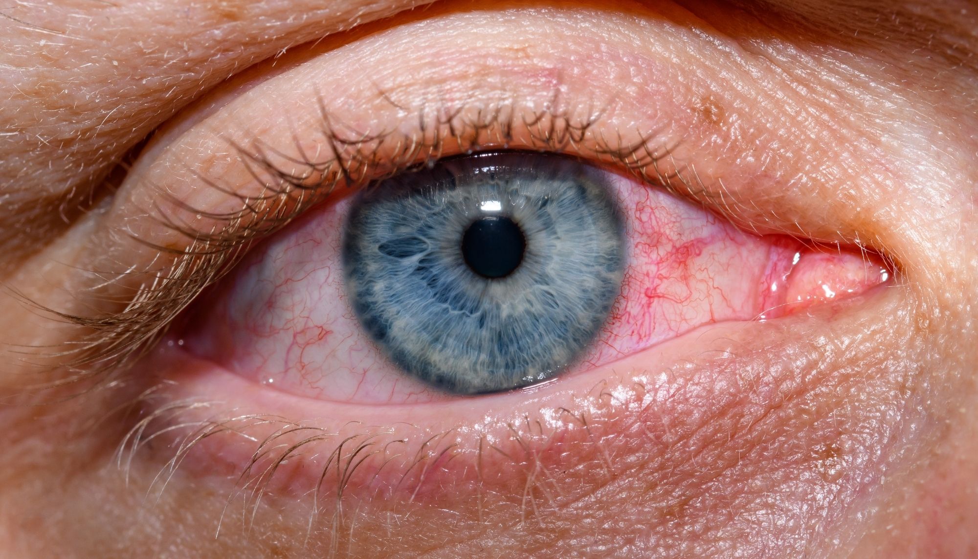 Conjunctivitis (Red Eye)