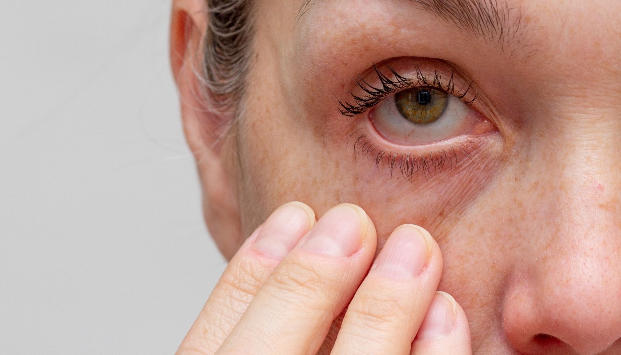 Dry Eye Syndrome