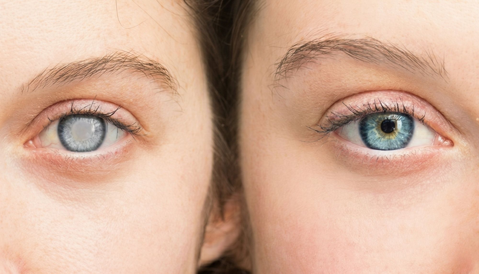 Glaucoma
