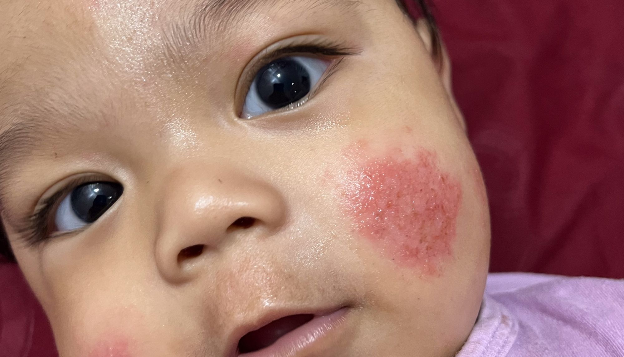 Skin Rashes in Children