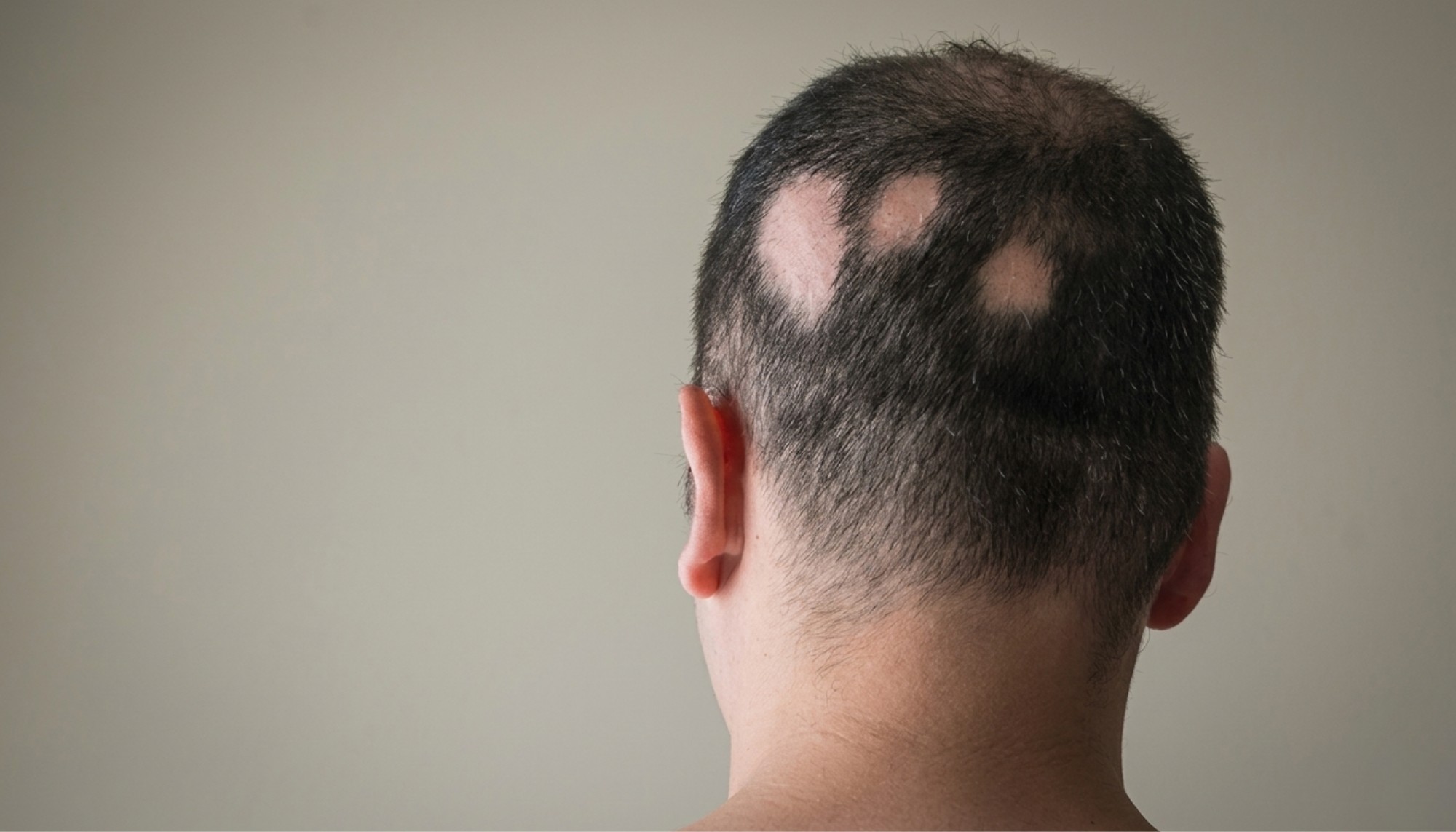 Alopecia Areata
