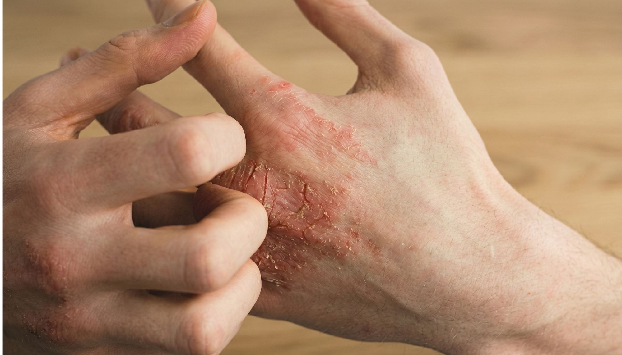 Contact Dermatitis / Allergies