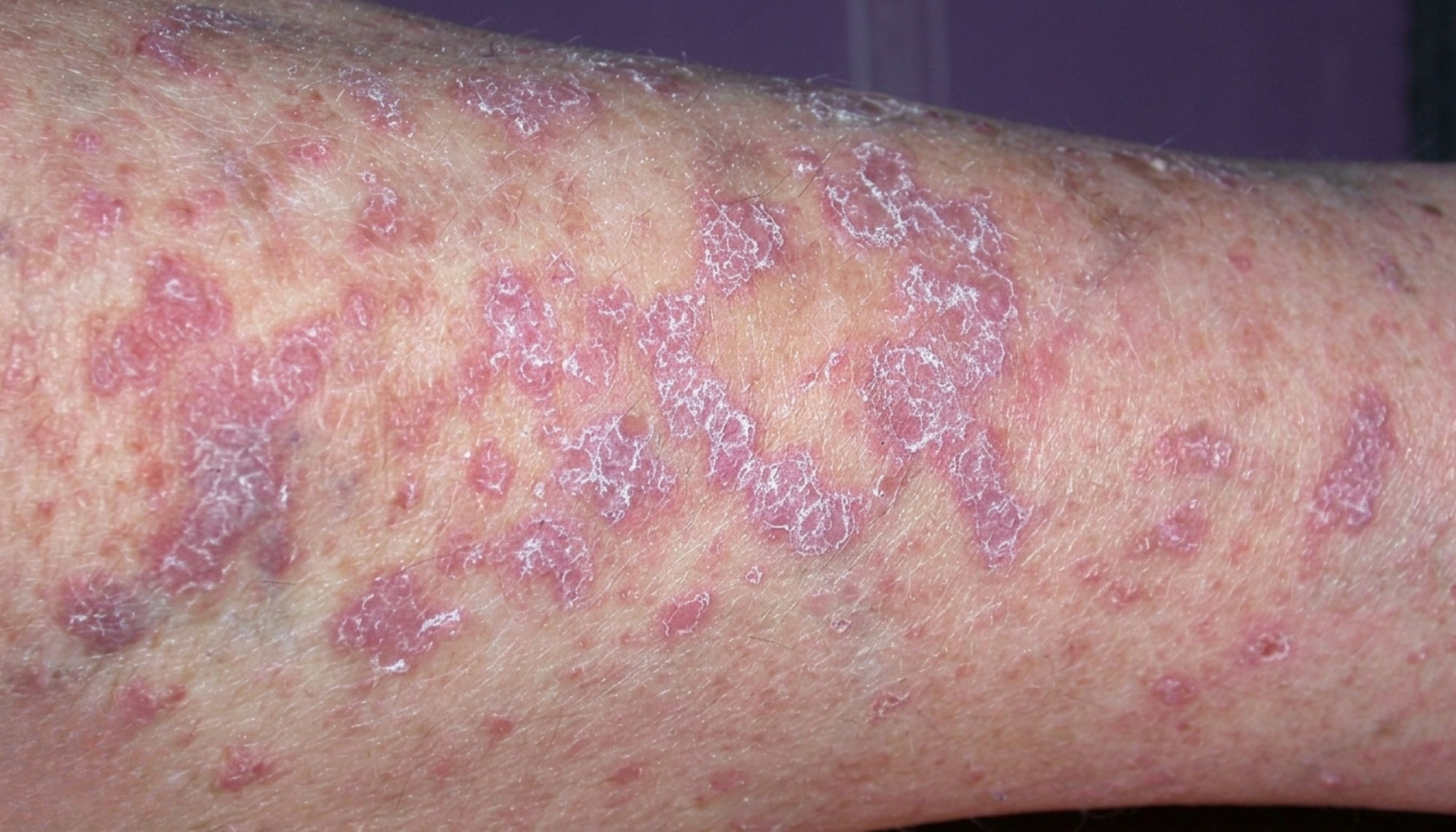 Lichen Planus