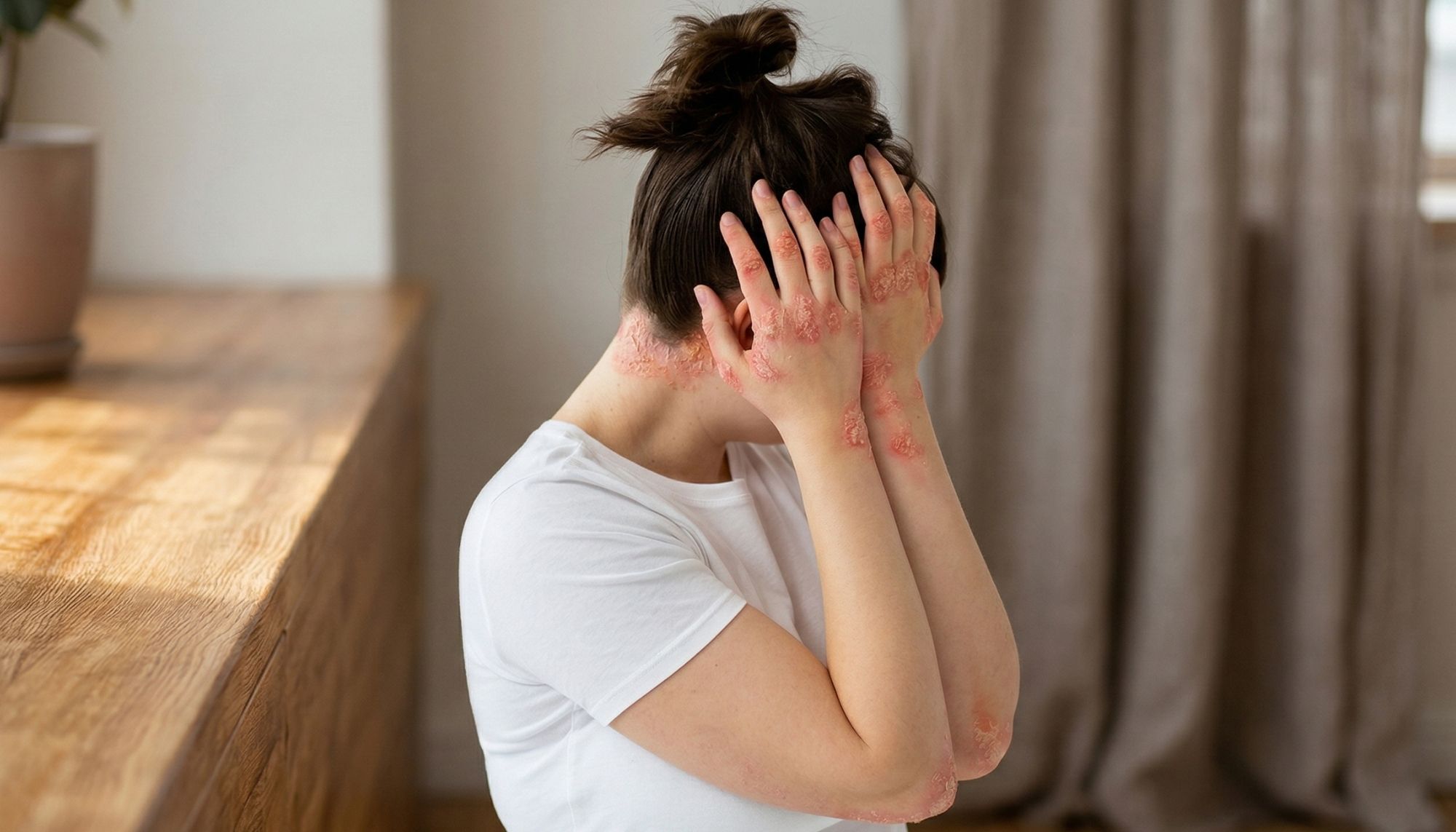 Psoriasis