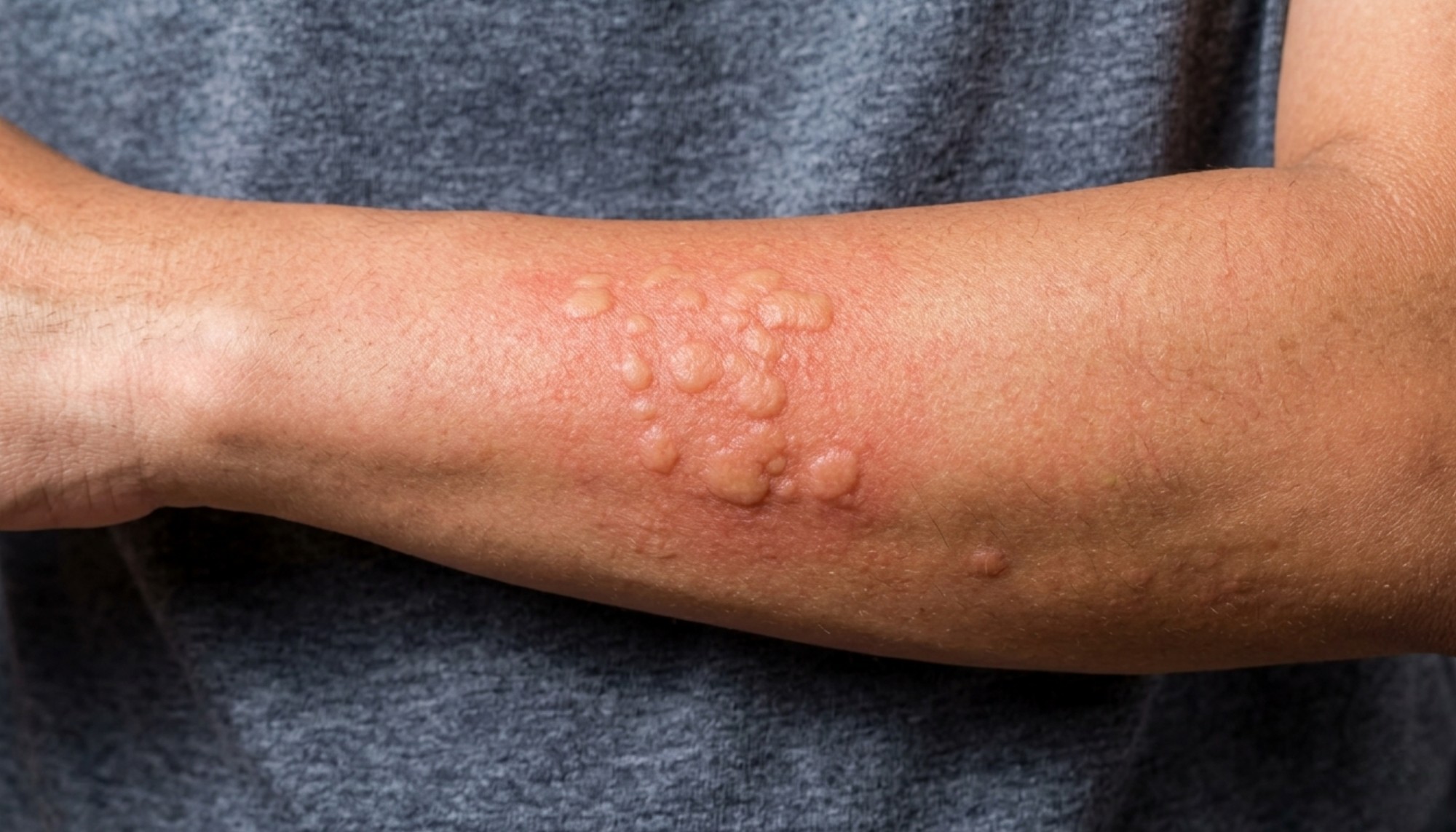 Urticaria / Hives