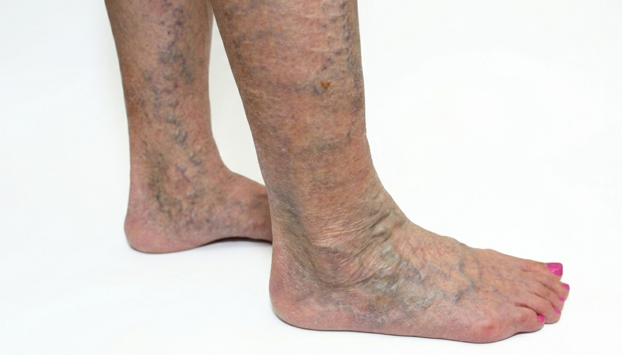 Varicose Eczema