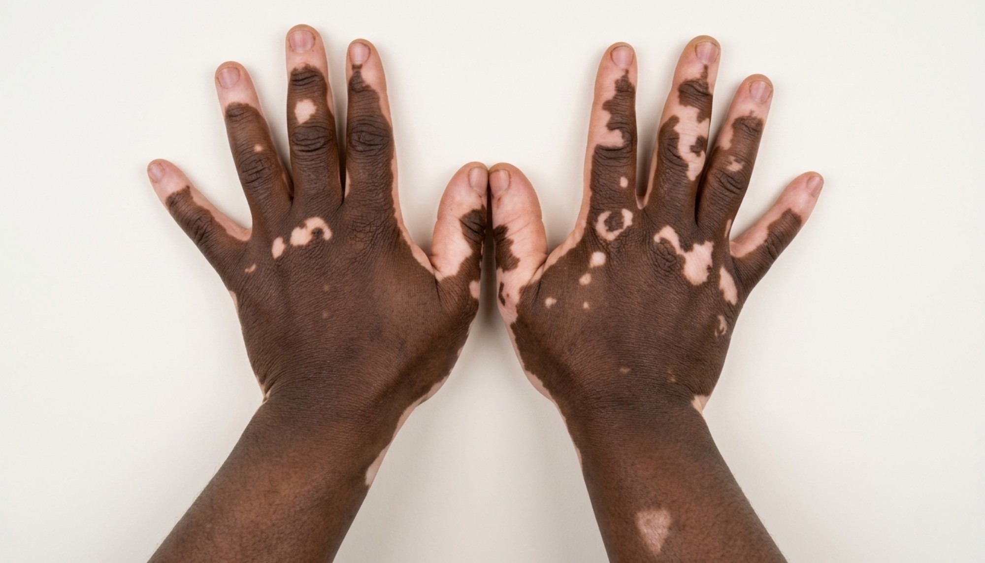 Vitiligo / Leukoderma