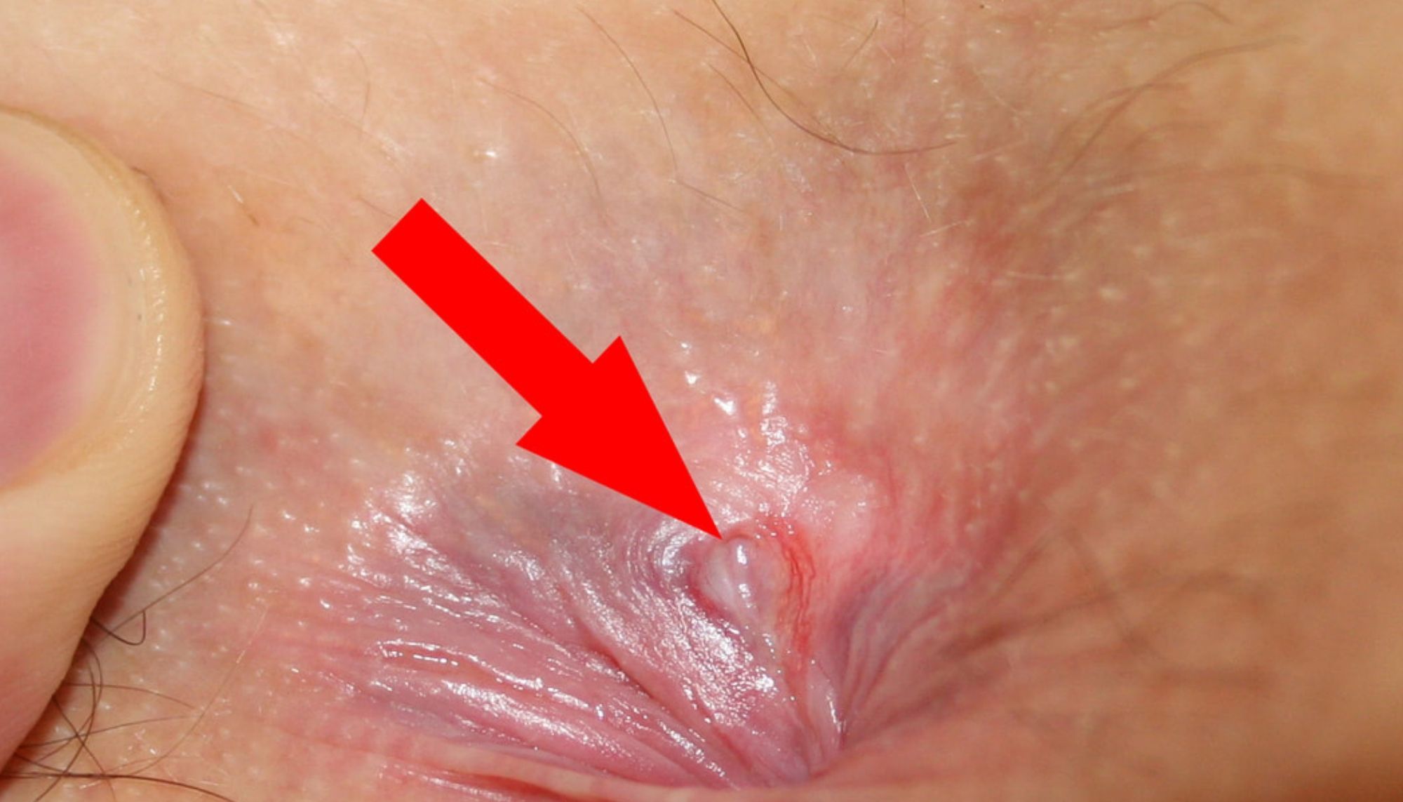 Anal Fissure