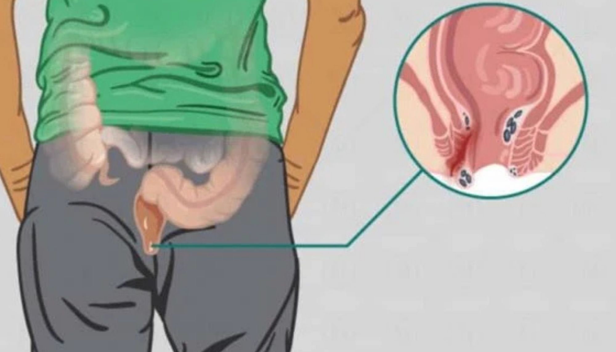 Fistula