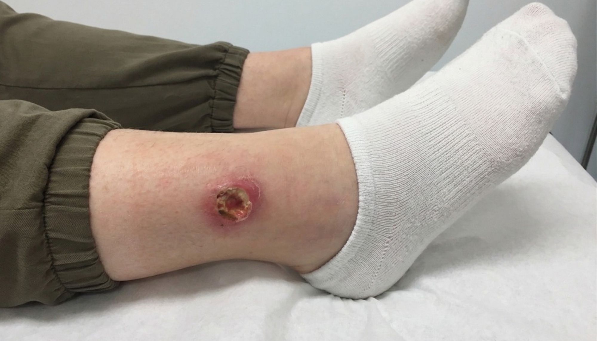 Non-Healing Ulcers