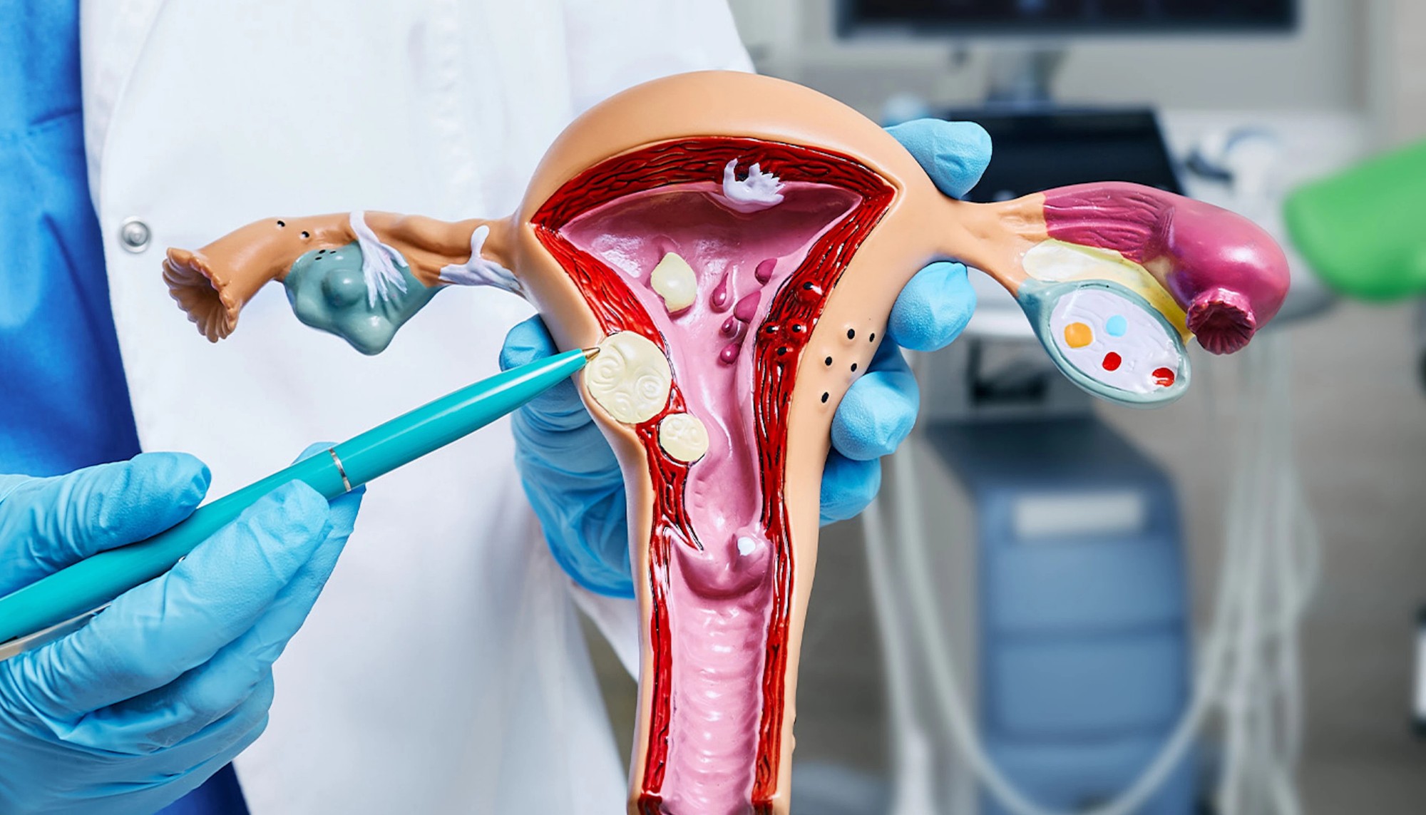 Uterine Fibroids