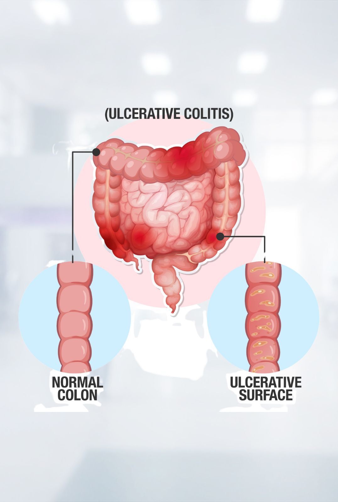 IBS 1