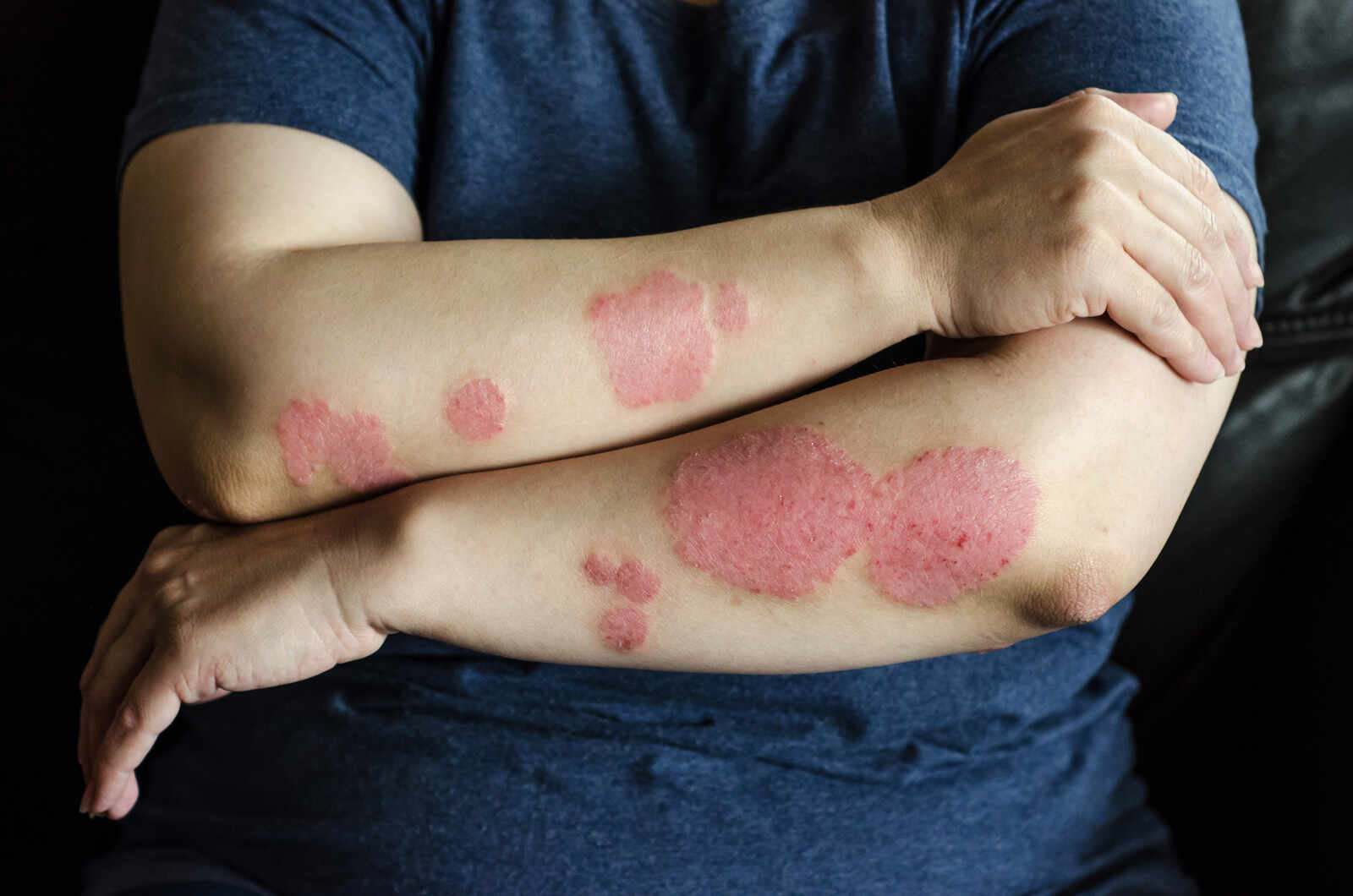 Psoriasis