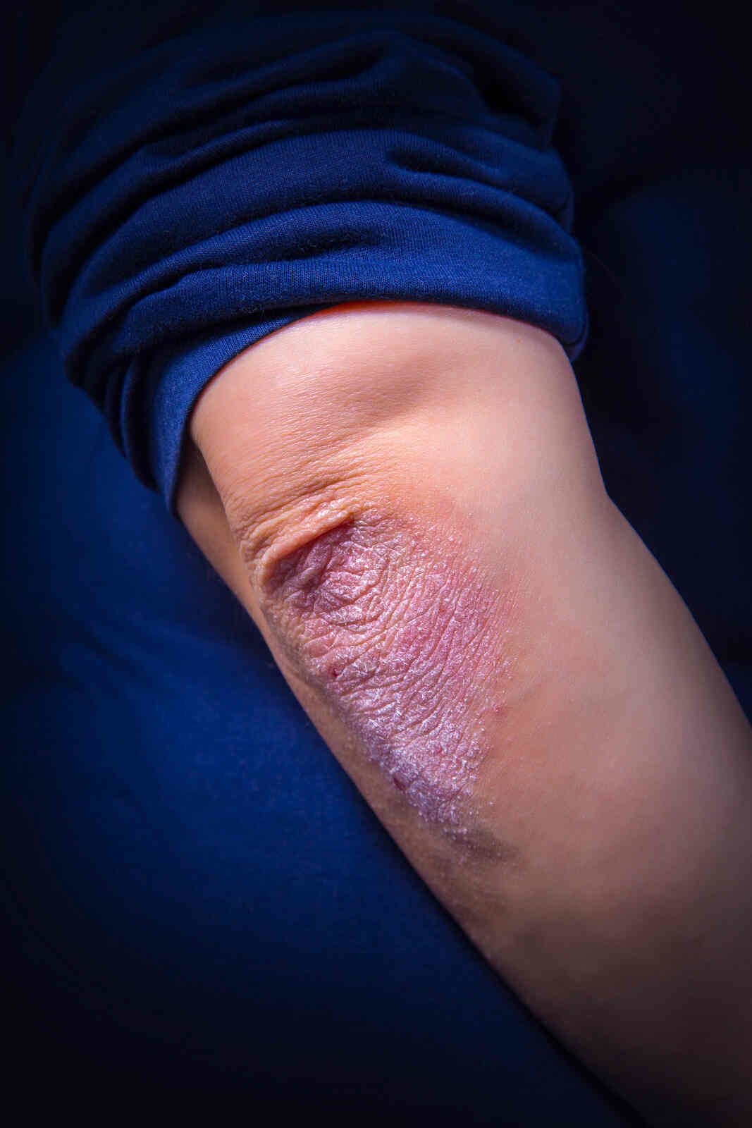 Psoriasis1