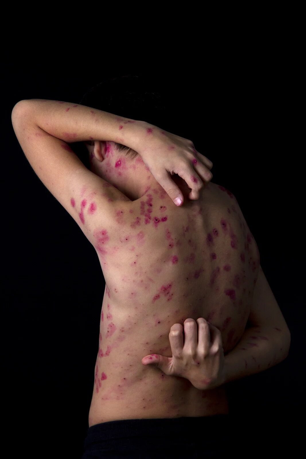 Psoriasis2