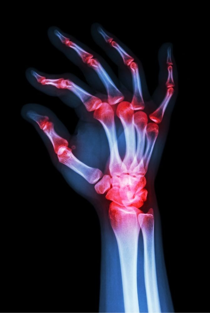 Rheumatoid Arthritis 2 1