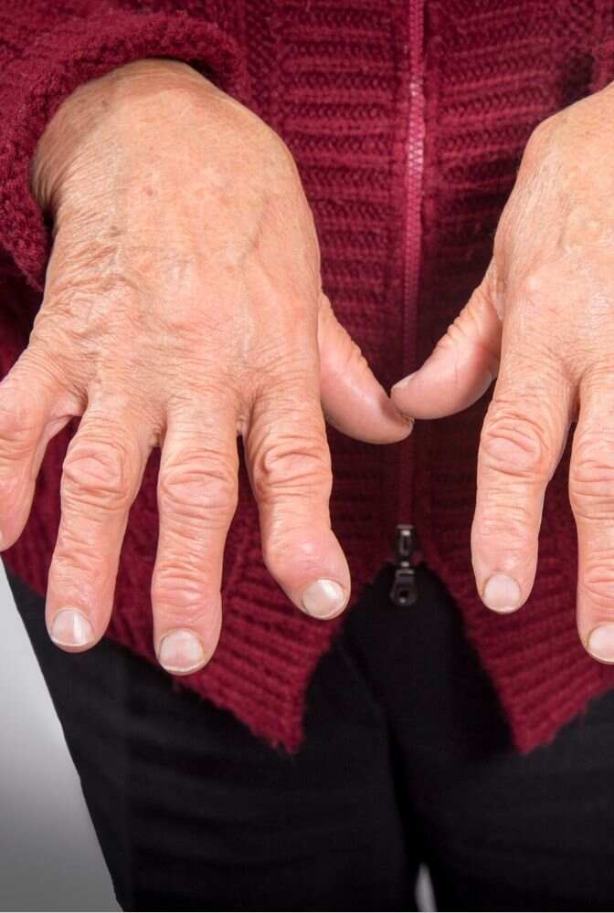 Rheumatoid Arthritis 3 1