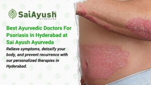 Best Ayurvedic Doctors For Psoriasis in Hyderabad